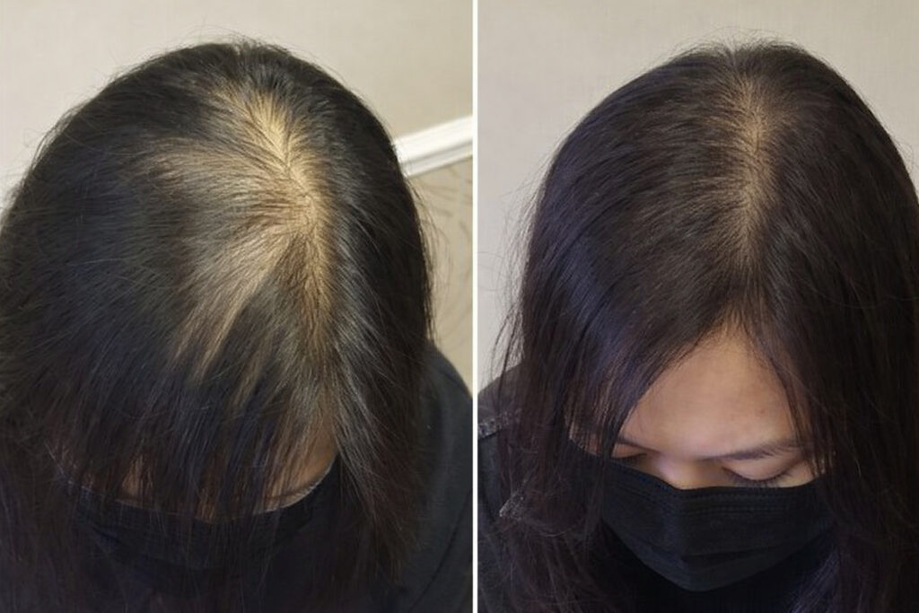scalp micropigmentation(4)