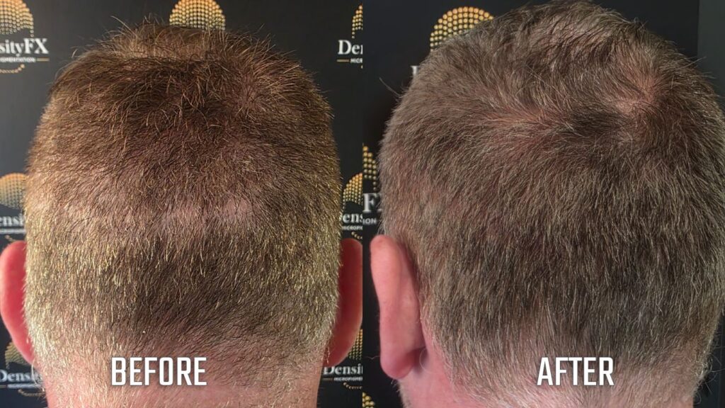 before and after Scar Camou