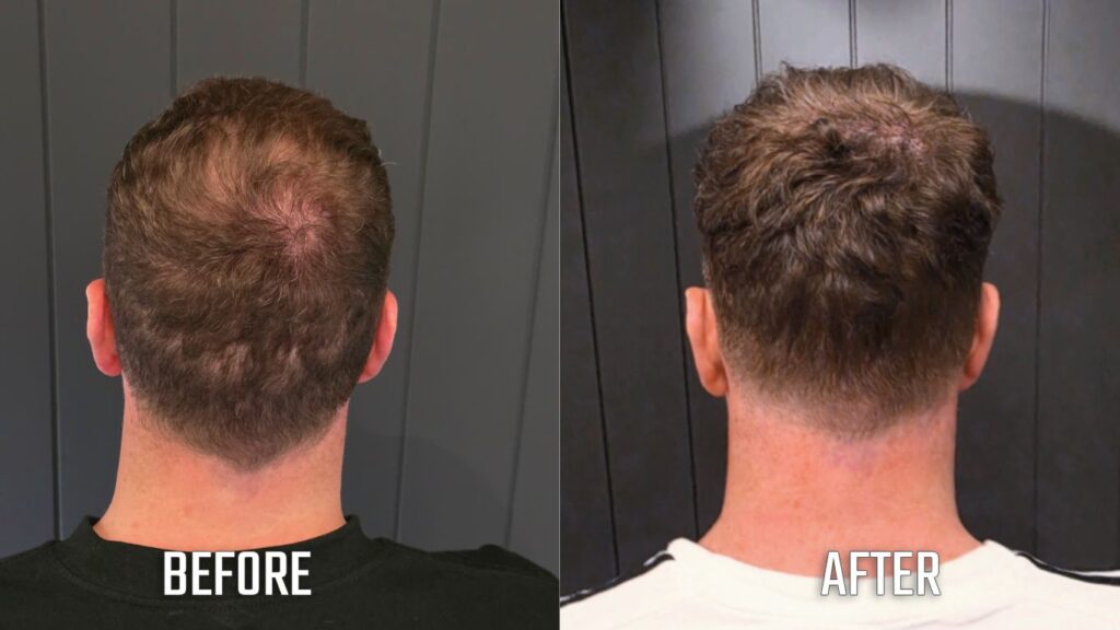 scar camou tattoo - before and after